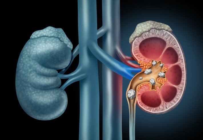 Kidney Stone Care(Non Surgical Management)